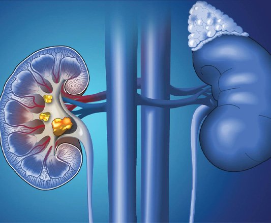 Nephrology & Kidney Care at Optimus Hospital Gurgaon