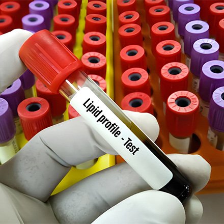 Lipid Profile