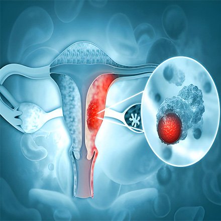 Pap Smear Cervical Cancer Screening